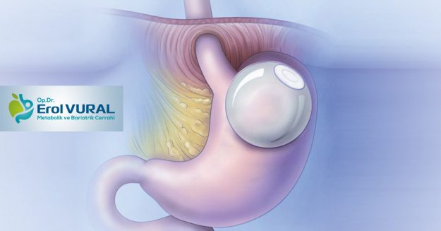 mide_balonu_avantajlari_ve_turleri_nelerdir