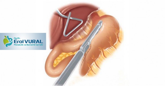 Tüp-Mide-Ameliyatinin-Uygulama-Sekilleri
