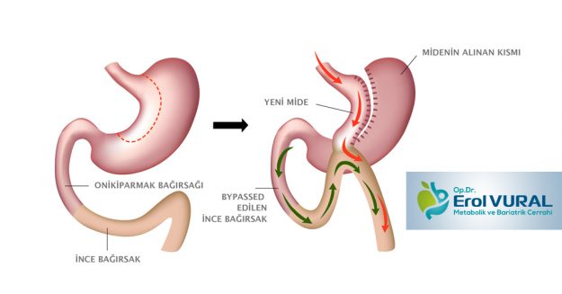 Roux_Y_Gastrik_Bypass Gastrik Bypass ameliyatı