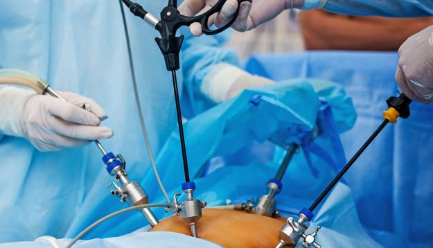 tup-mide-sleeve-gastrektomi-ameliyati-nedir-1