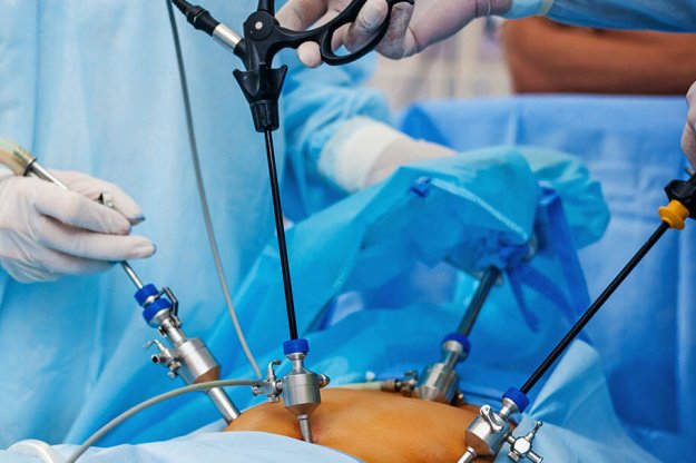 tup-mide-sleeve-gastrektomi-ameliyati-nedir-1